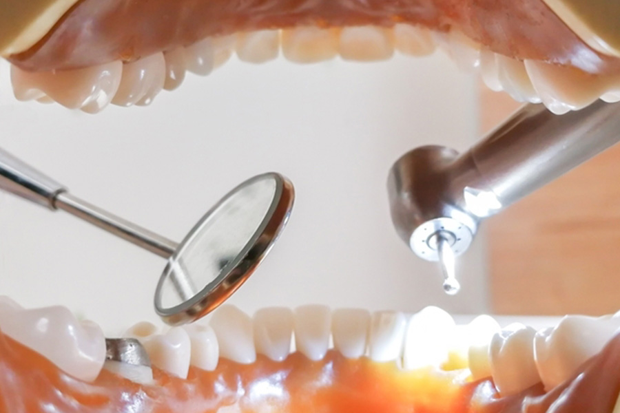 抜歯から歯を救うための歯内療法・根管治療とは