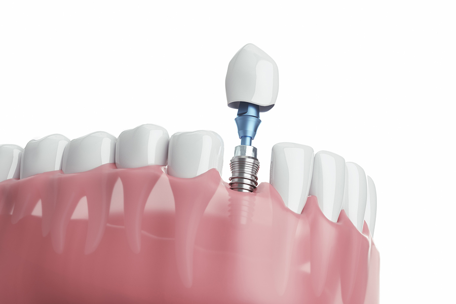 インプラント治療