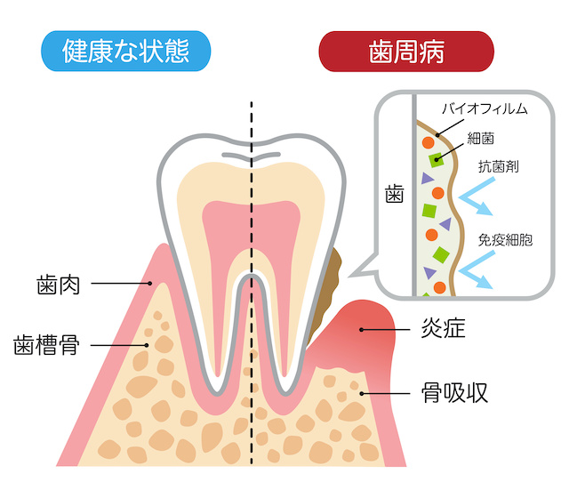 歯周病のなりたち