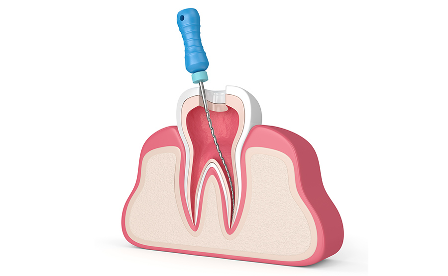 根管治療とは